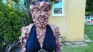 The Woman Covered in Thousands of Tumors