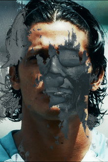Vitiligo