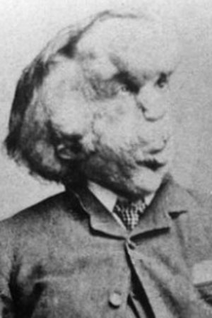Foto de Joseph Merrick