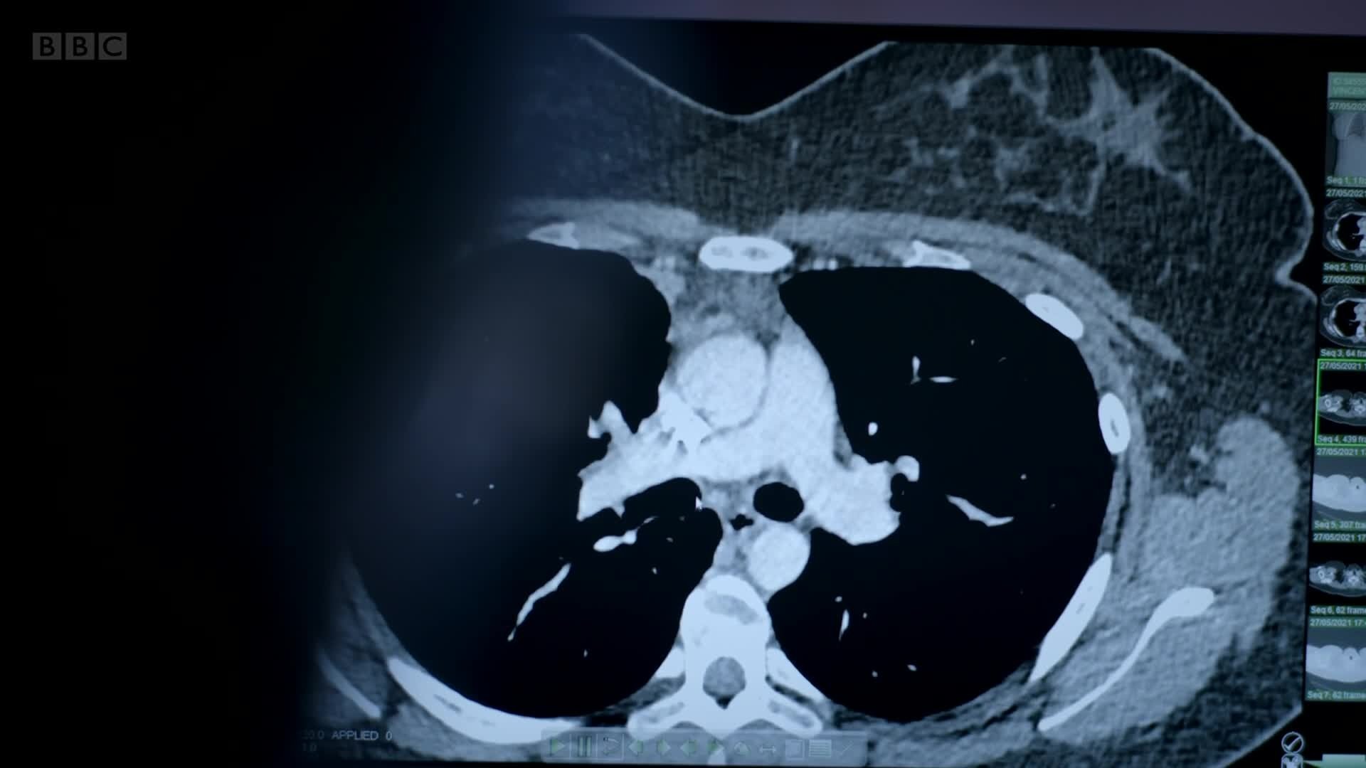 Surgeons: At the Edge of Life
