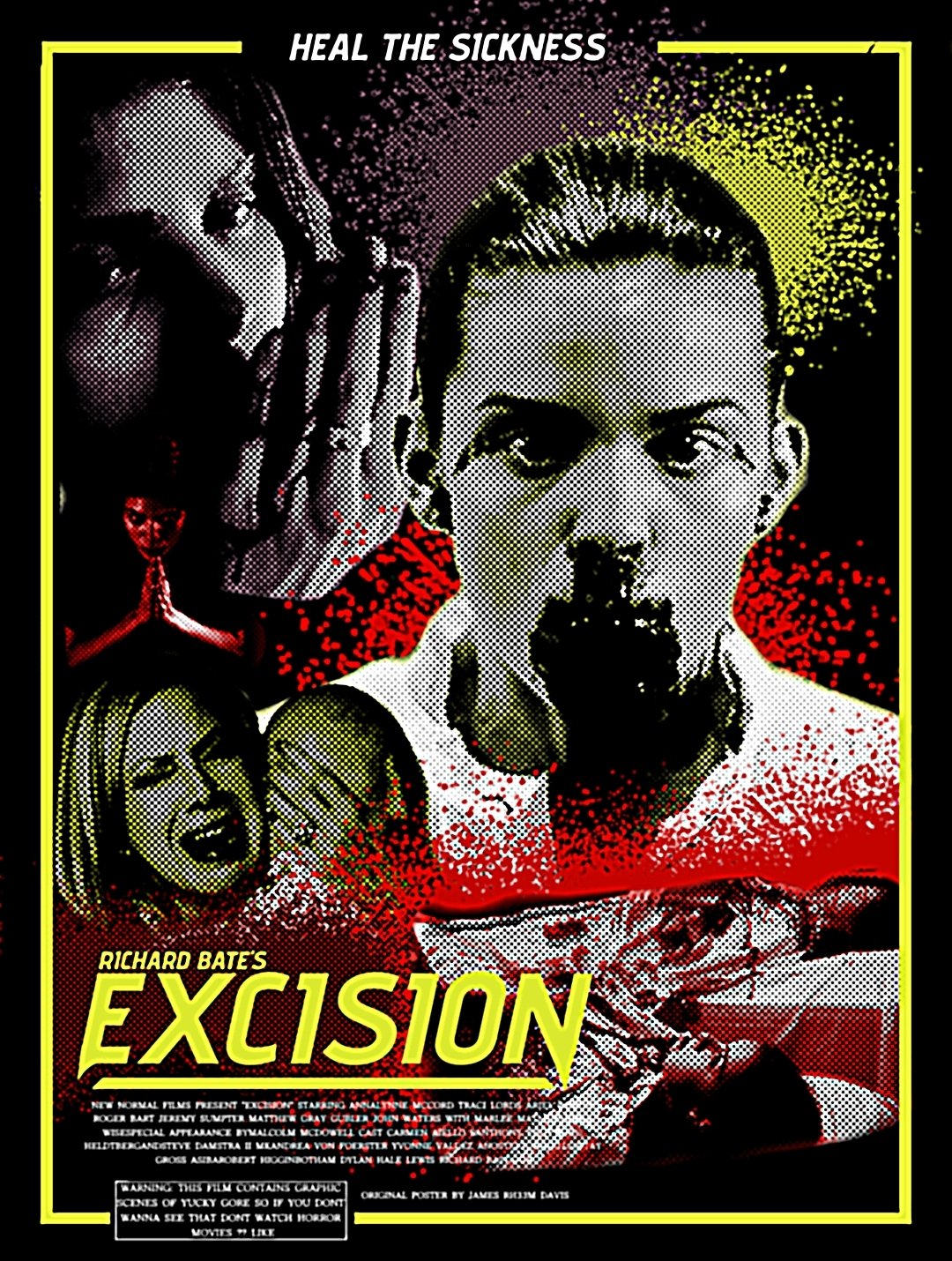 Excision