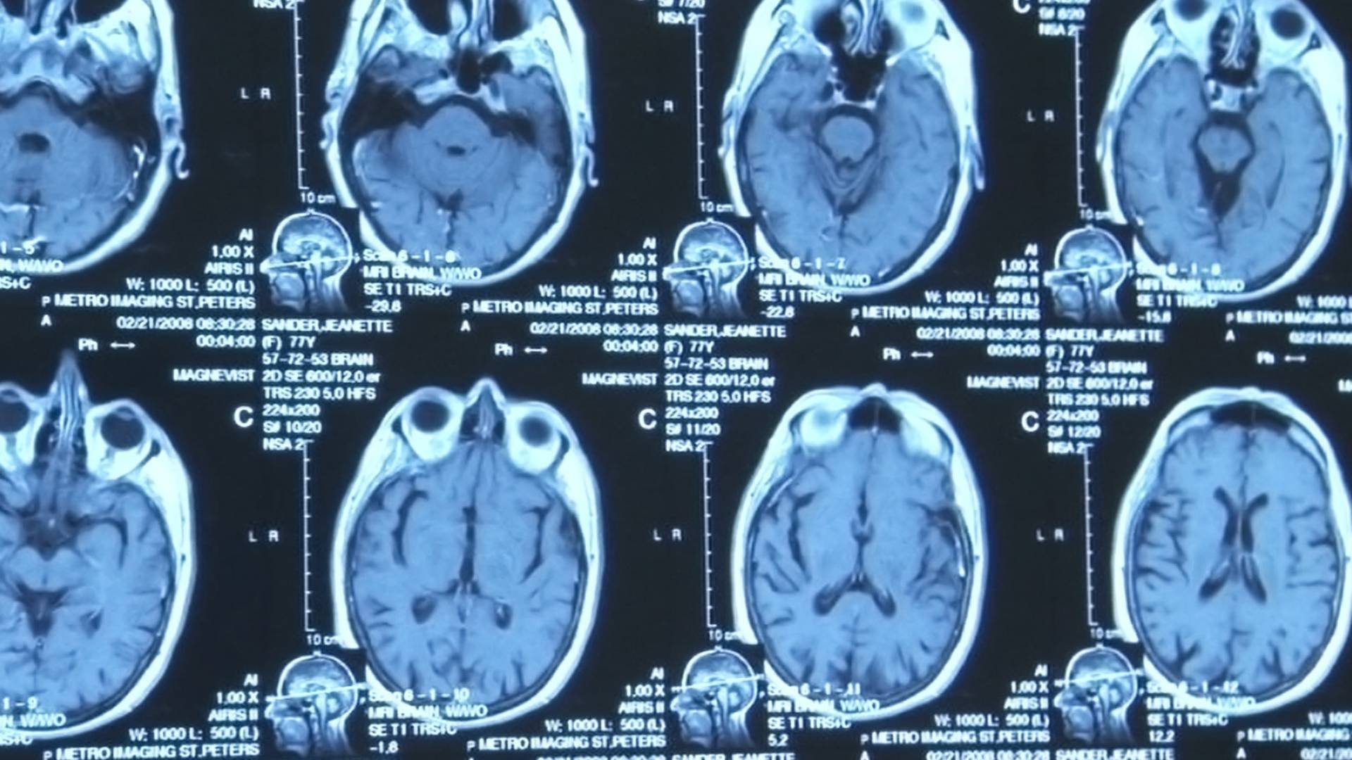 The Alzheimer's Project