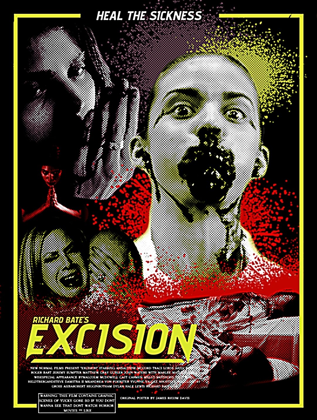 Excision