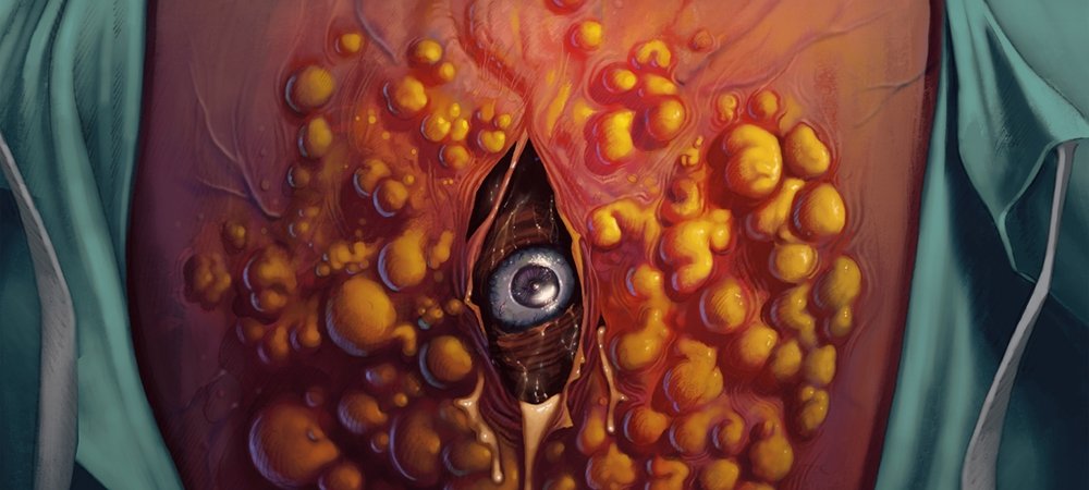Backdrop of Cyst