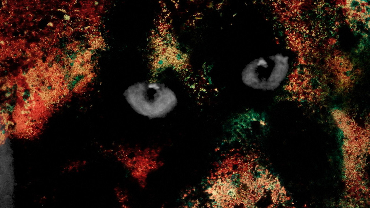 Pigment-Dispersion Syndrome still 8