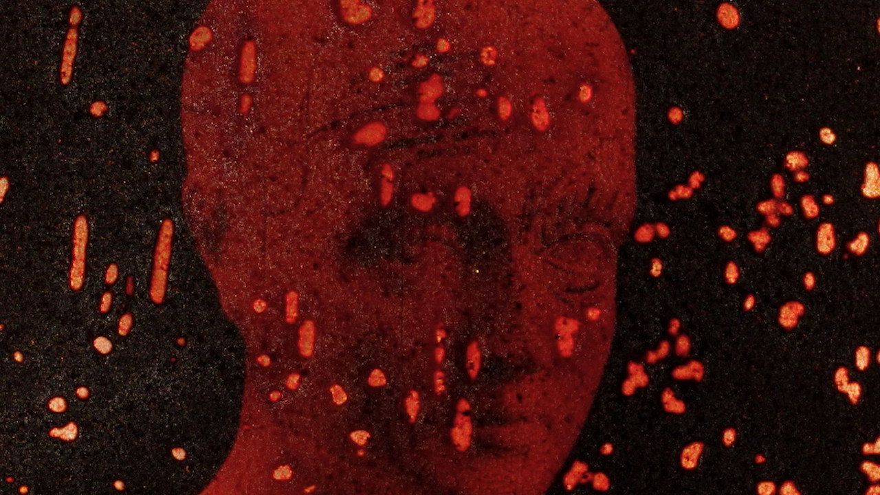 Pigment-Dispersion Syndrome still 9