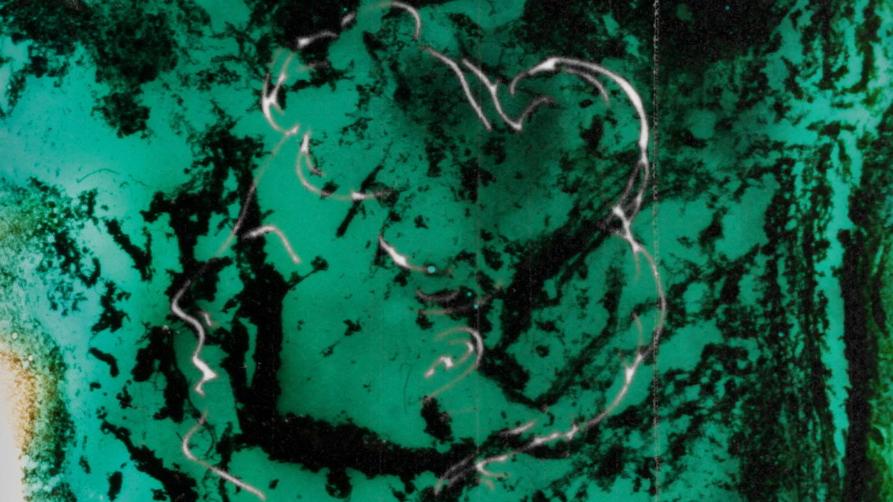 Pigment-Dispersion Syndrome still 6