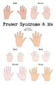 Fraser Syndrome & Me (1970)