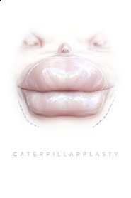 Imagen de Caterpillarplasty