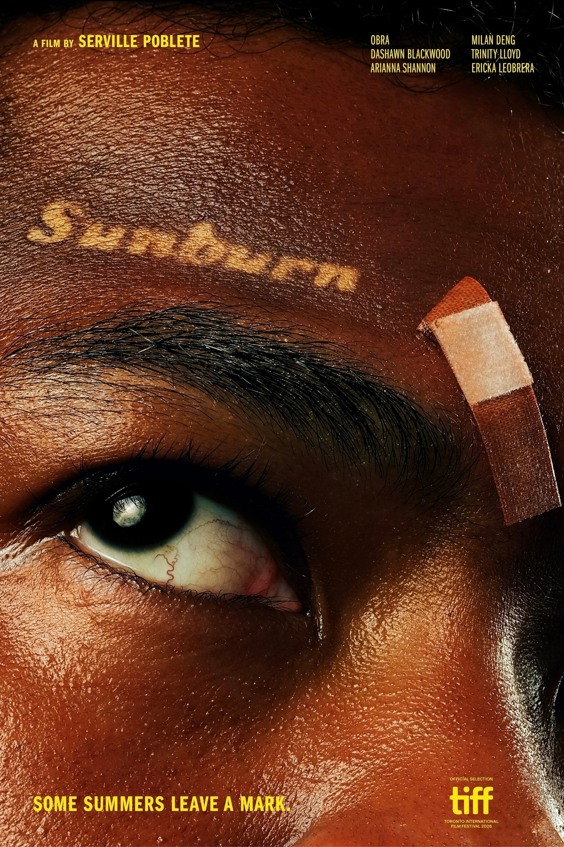 Sunburn