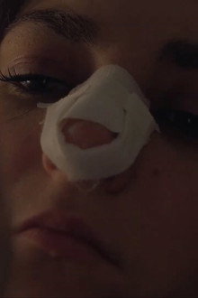 Nosebleed