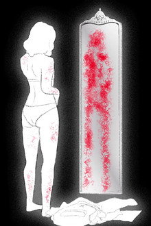Excoriación