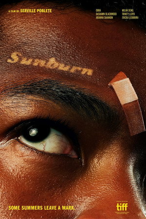 Sunburn