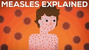 Kurzgesagt - In a Nutshell Measles Explained — Vaccinate or Not?