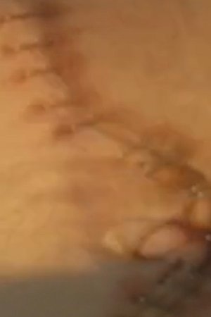 Suite: Double Nephrectomy