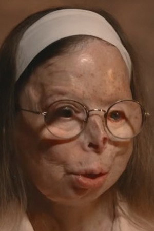 Acid-burned by the man she had just left, she is left disfigured.