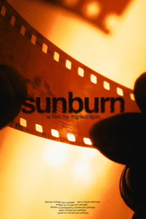 sunburn