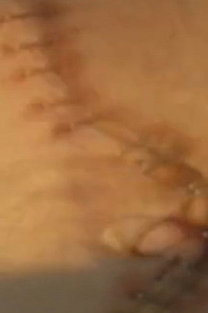 Suite: Double Nephrectomy