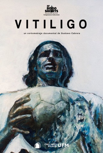 Vitiligo (2025)