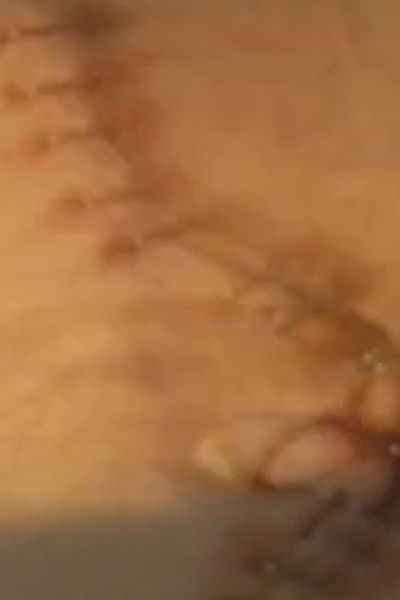 Poster do Filme Suite: Double Nephrectomy