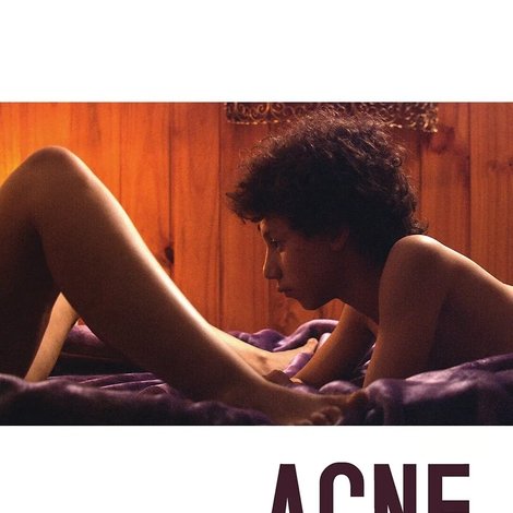 Acné
