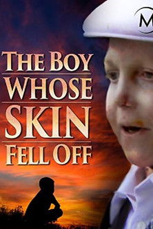 The Boy Whose Skin Fell Off