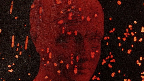 Pigment-Dispersion Syndrome