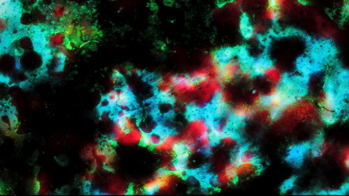 Pigment-Dispersion Syndrome
