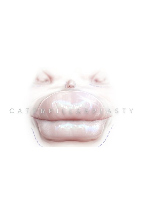 Caterpillarplasty 2018