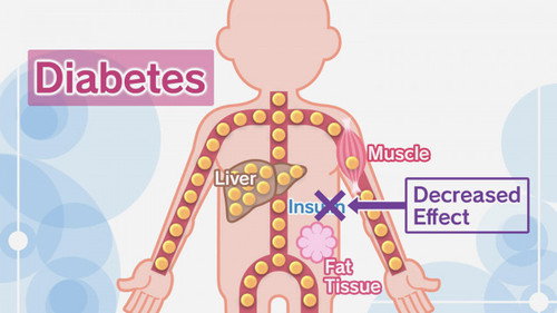 Solutions for Diabetes: #1 This is the Cause!