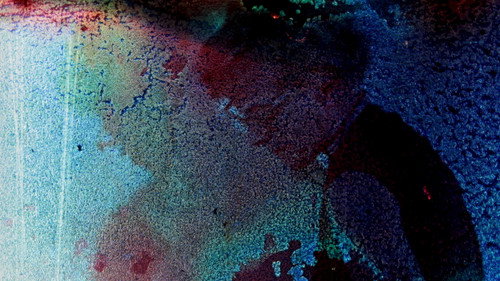 Pigment-Dispersion Syndrome