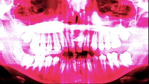 Schizophrenic perpetual hemorrhage from the reichian perspective still