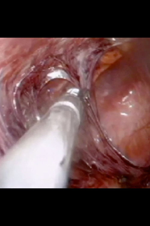 Laparoscopic Surgery