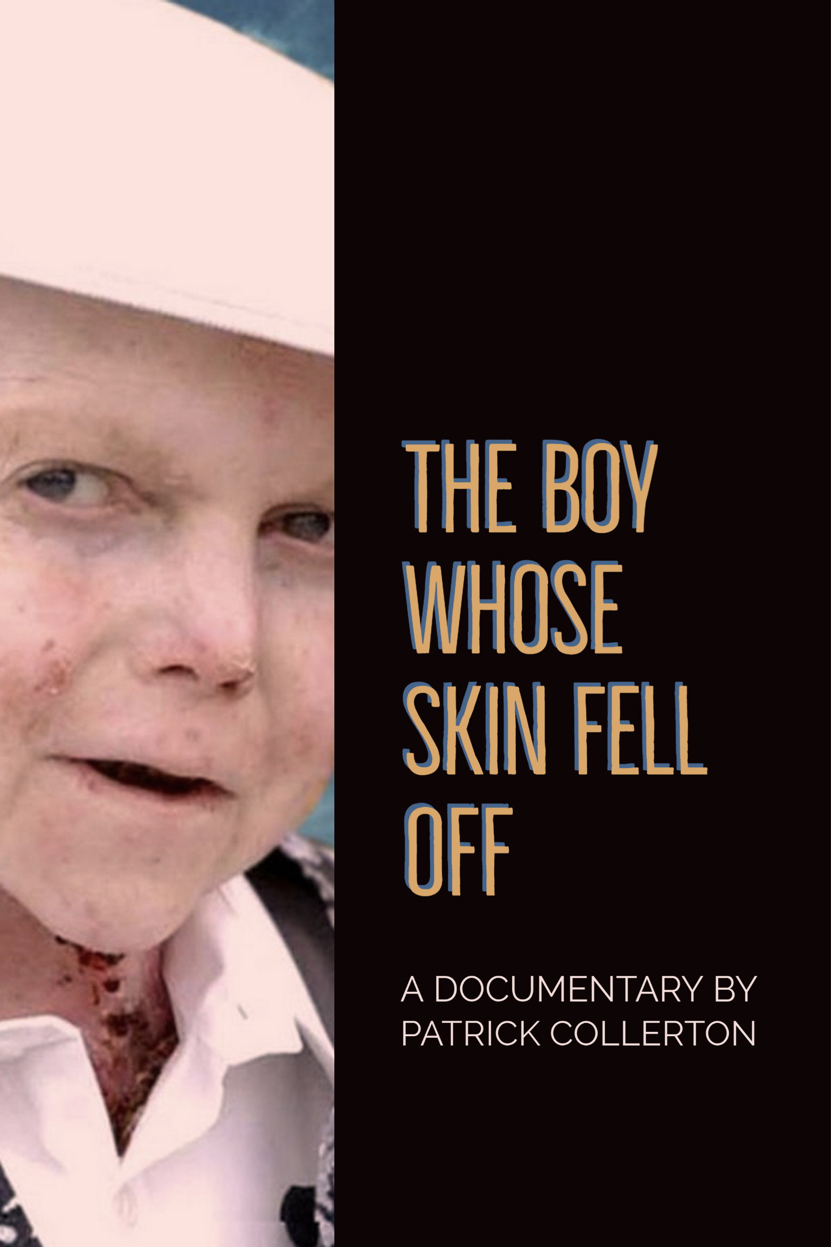The Boy Whose Skin Fell Off
