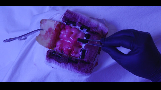 Implant