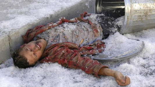 Frostbite