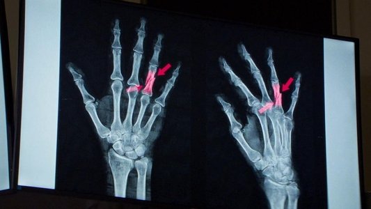Anatomie d'une chute