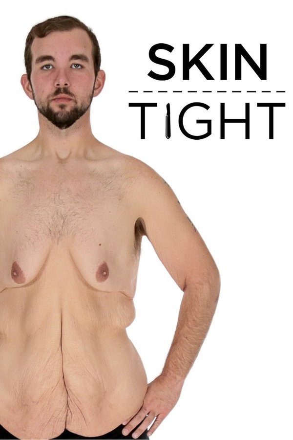 My 600-lb Life: Skin Tight My 600-lb Life: Skin Tight