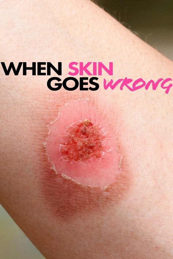 When Skin Goes Wrong