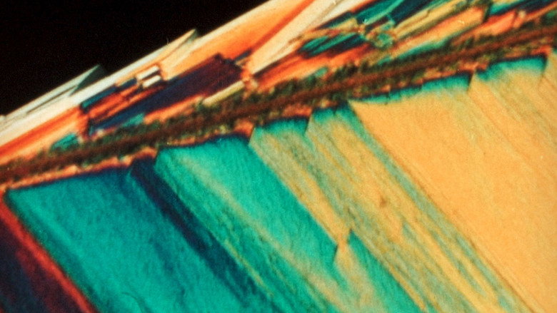 Imatge de Pigment-Dispersion Syndrome