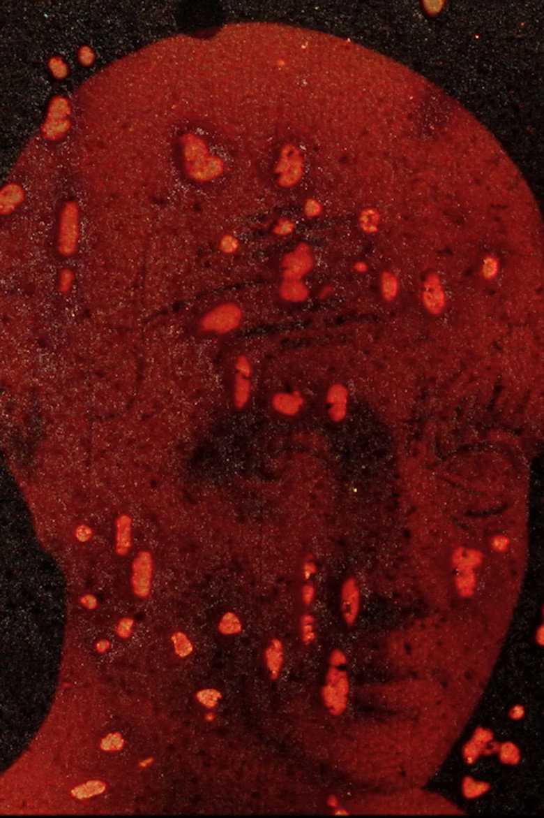 Imatge de Pigment-Dispersion Syndrome