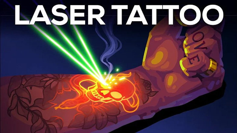 Tattoo Removal Is Insane
