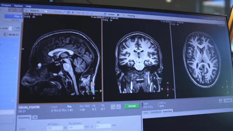Imatge de Migraine : la fin du casse-tête ?