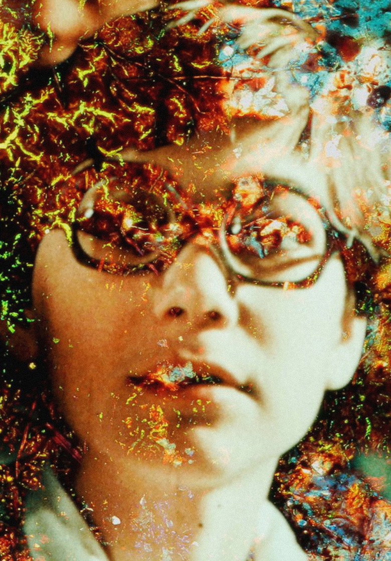 Imatge de Pigment-Dispersion Syndrome