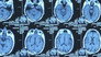 The Alzheimer's Project: Momentum in Science (Part 1)